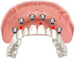 TEETH TREATMENT CLINIC IN PATNA CITY