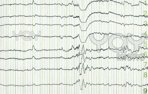 EEG CENTER IN PATNA