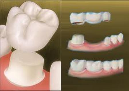 DENTAL CLINIC FIXED TEETH IN PATNA