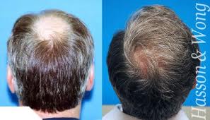 HAIR TRANSPLANTATION CENTRE IN PATNA