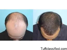 BEST HAIR TRANSPLANTATION CENTRE IN  PATNA