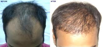 HAIR TREATMENT IN BIHAR