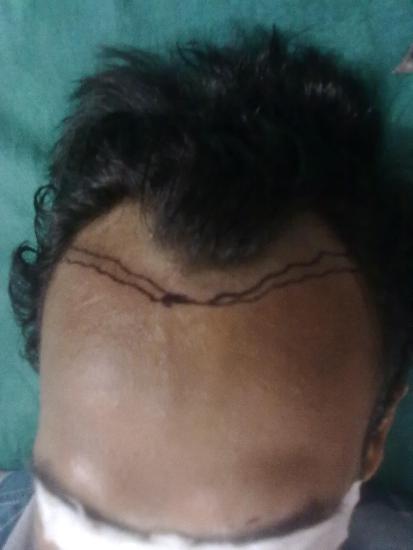 hair transplantation 1 before oper