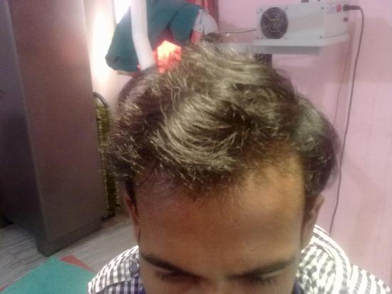 hair transplantation 1after oper