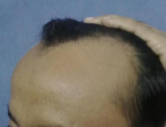 hair transplantation 2 before oper