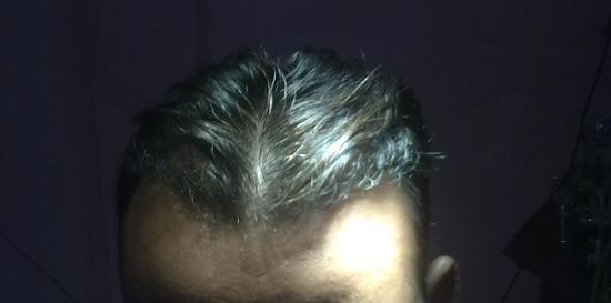 hair transplantation 2 after oper