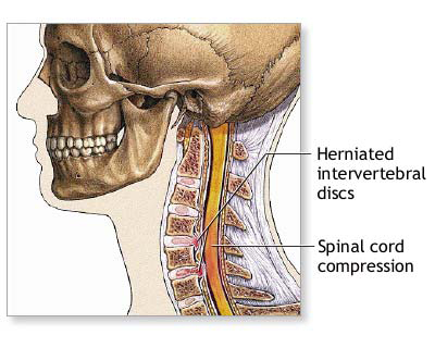 SPONDYLOSIS TREATMENT IN PATNA