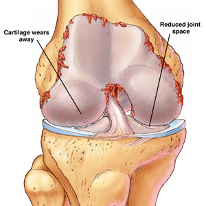 ARTHRITIS TREATMENT IN PATNA