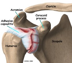 FROZEN SHOULDER TREATMENT IN PATNA