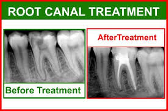 BEST RCT TREATMENT IN PATNA