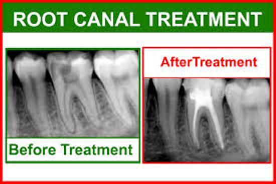 BEST RCT TREATMENT IN PATNA