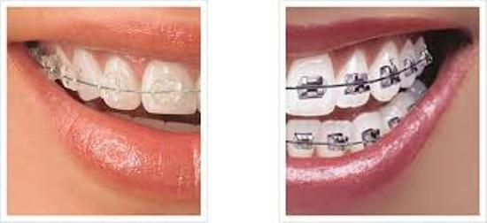 BEST FIXED TEETH TREATMENT IN PATNA