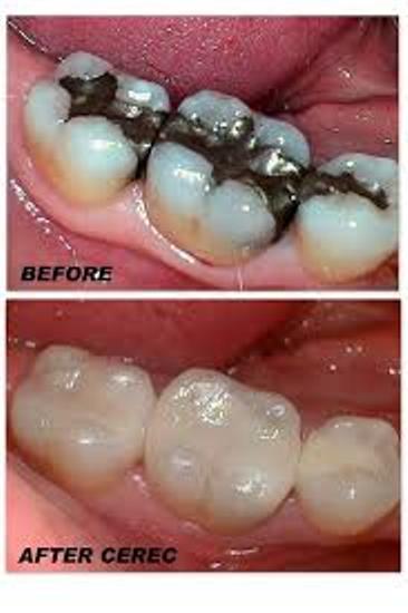 BEST CROWN FIXATION TREATMENT IN PA