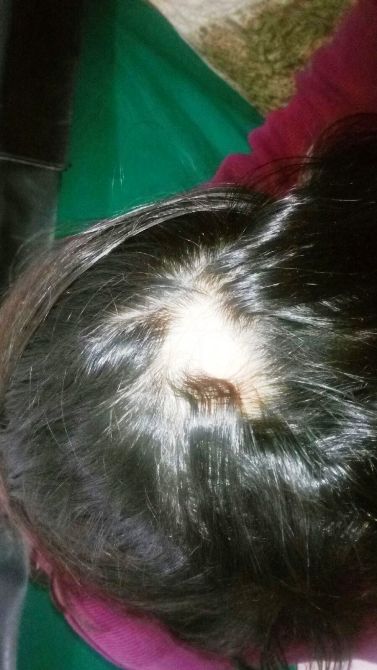 permanent and natural hair regrowth in ranchi