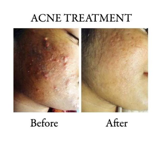 Acne and acne scars treatment in ranchi