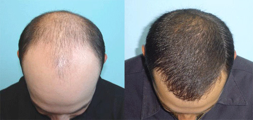 HAIR LOSS TREATMENT IN HAZARIBAGH