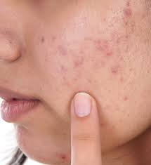 pimple scars clinic near sector ranchi