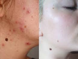 pimple marks clinic near sail city ranchi