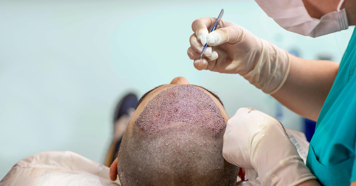 hair transplant clinic near Birsa Chowk ranchi