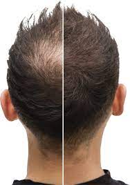 HAIR REGROWTH CLINIC NEAR HINU RANCHI