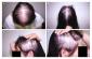 HAIR LOSS FOR FEMALE CLINIC NEAR BIRSA CHOWK RANCHI