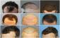 HAIR TRANSFORMATION CLINIC NEAR HAWAI NAGAR RANCHI