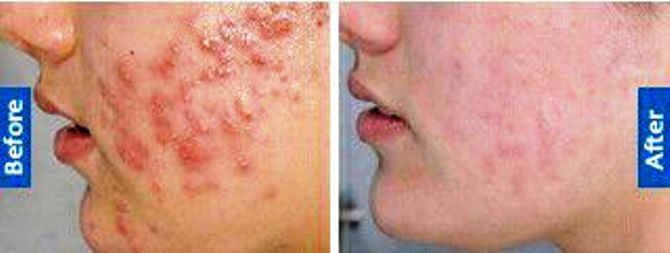 ONE TREATMENT GET RID IN FEW DAYS IN RANCHI