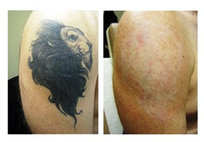 HAIR TRANSPLANT CENTER IN GIRIDIH 