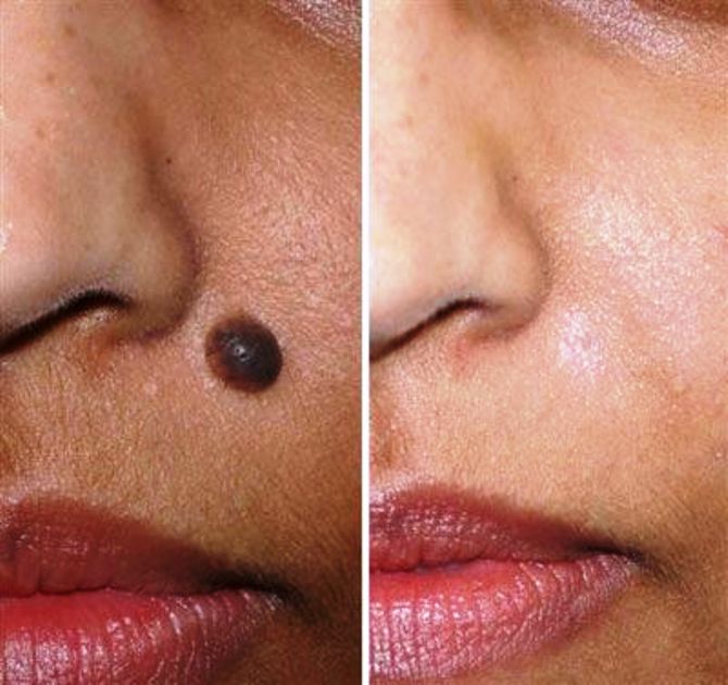 TOP MOLE REMOVAL CENTER IN DALTONGANJ 