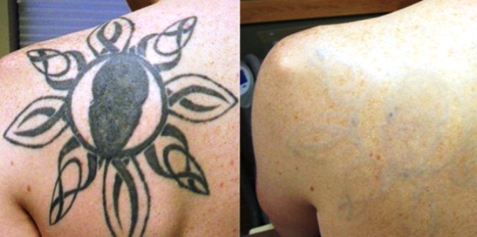 skin laser tattos removal center in ranchi