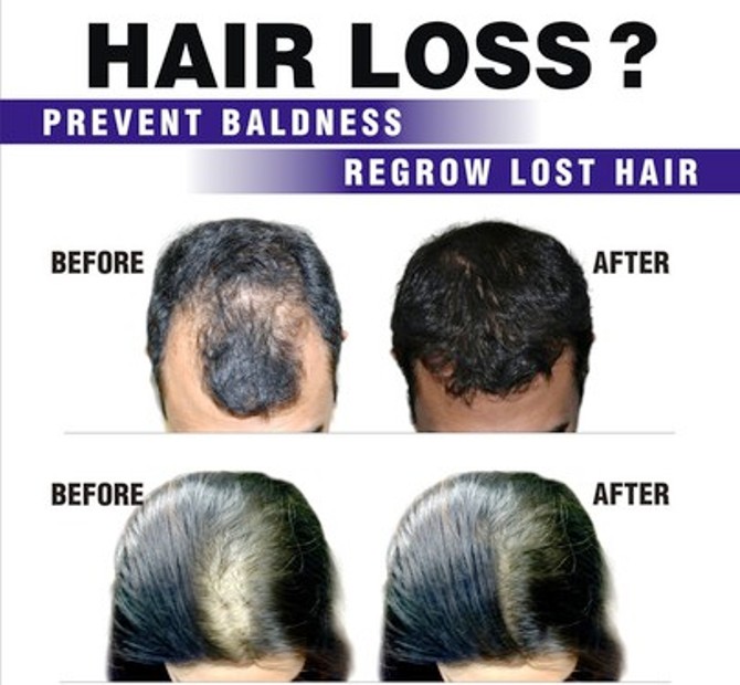 HAIR FALL TREATEMENT CENTER IN RANCHI