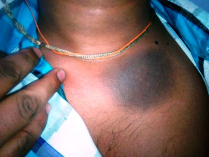 TAGS REMOVAL CENTER IN RANCHI