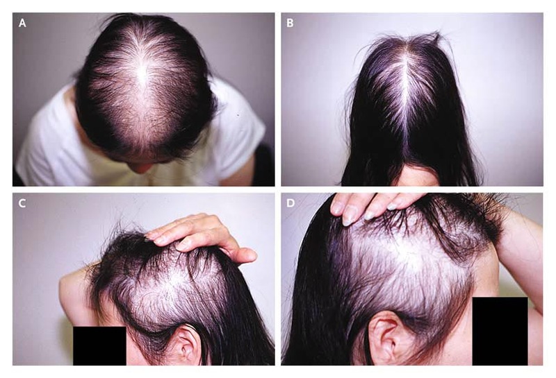 HAIR LOSS FOR FEMALE CLINIC NEAR BIRSA CHOWK RANCHI | KAV DENTAL COSMETIC & HAIR  TRANSPLANT CLINIC